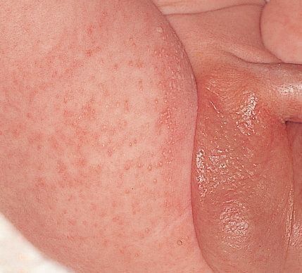 赤ちゃんの皮膚の病気 皮膚カンジダ症の症状とケア 医師監修 たまひよ